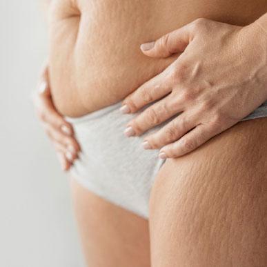 Stretch Marks, Natural Home Remedies & How to Reduce Them